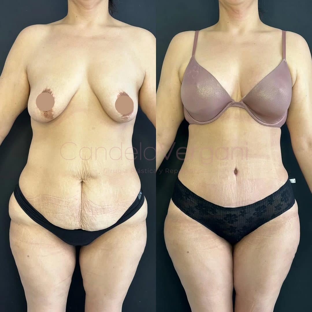 01a. Mommy Makeover