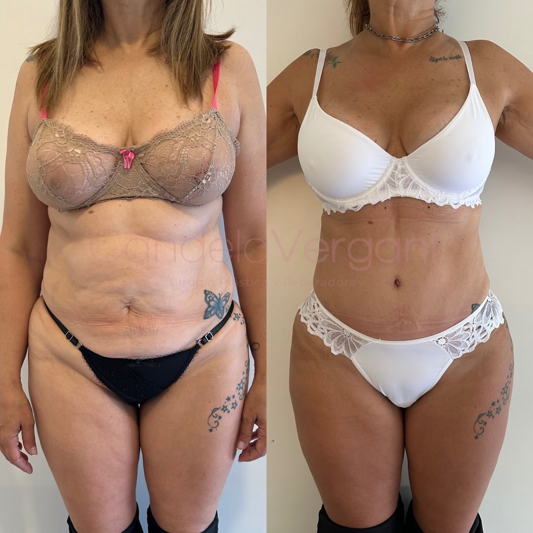 02a. Lipoabdominoplastia