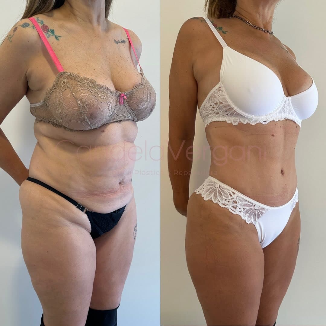 02b. Lipoabdominoplastia