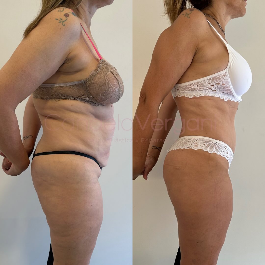 02c. Lipoabdominoplastia