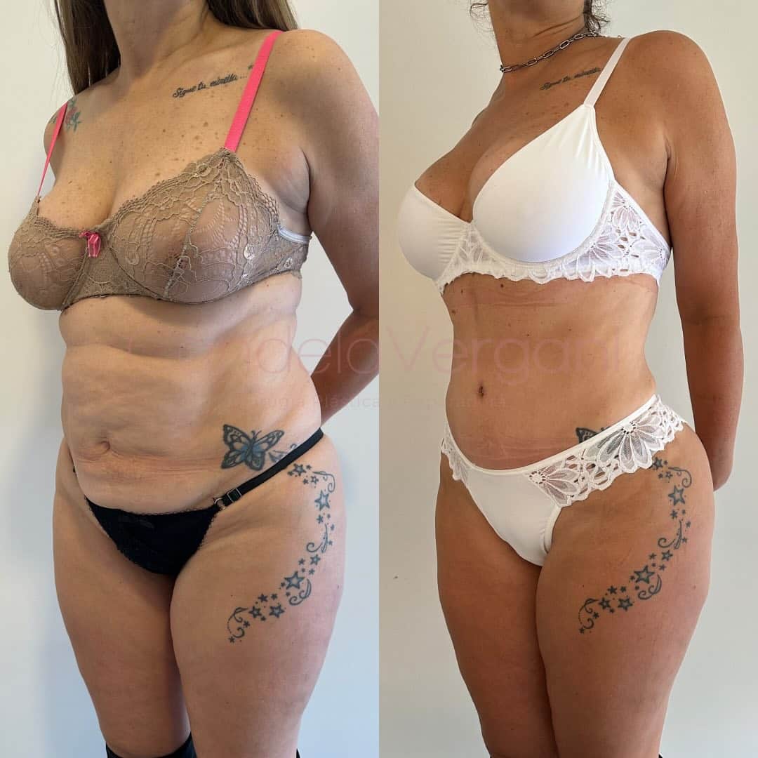02d. Lipoabdominoplastia