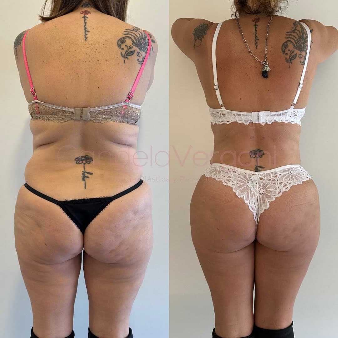 02e. Lipoabdominoplastia