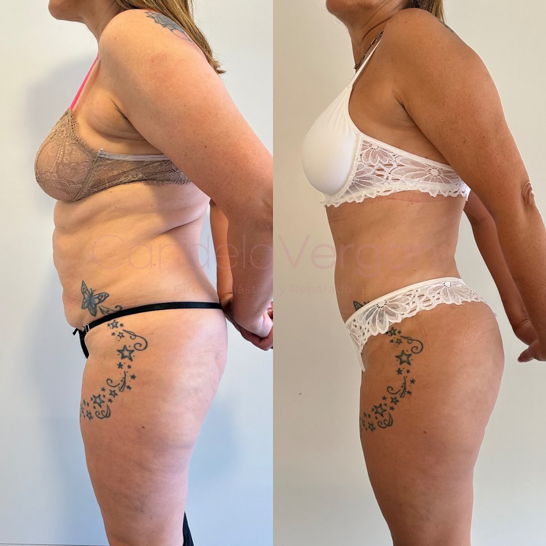 02e. Lipoabdominoplastia(1)