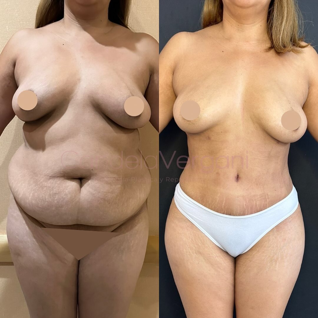 03a. Lipoabdominoplastía