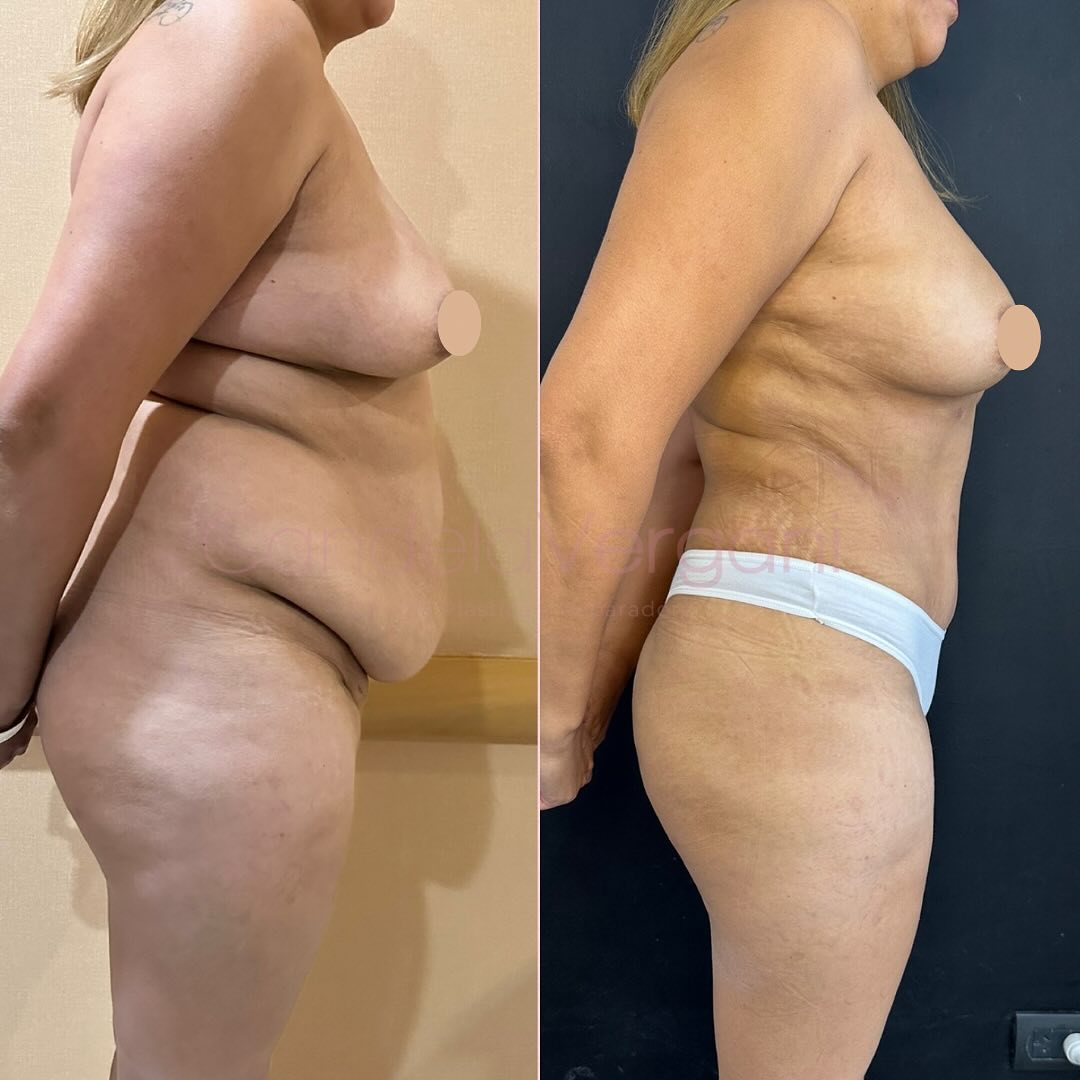 03c. lipoabdominoplastia