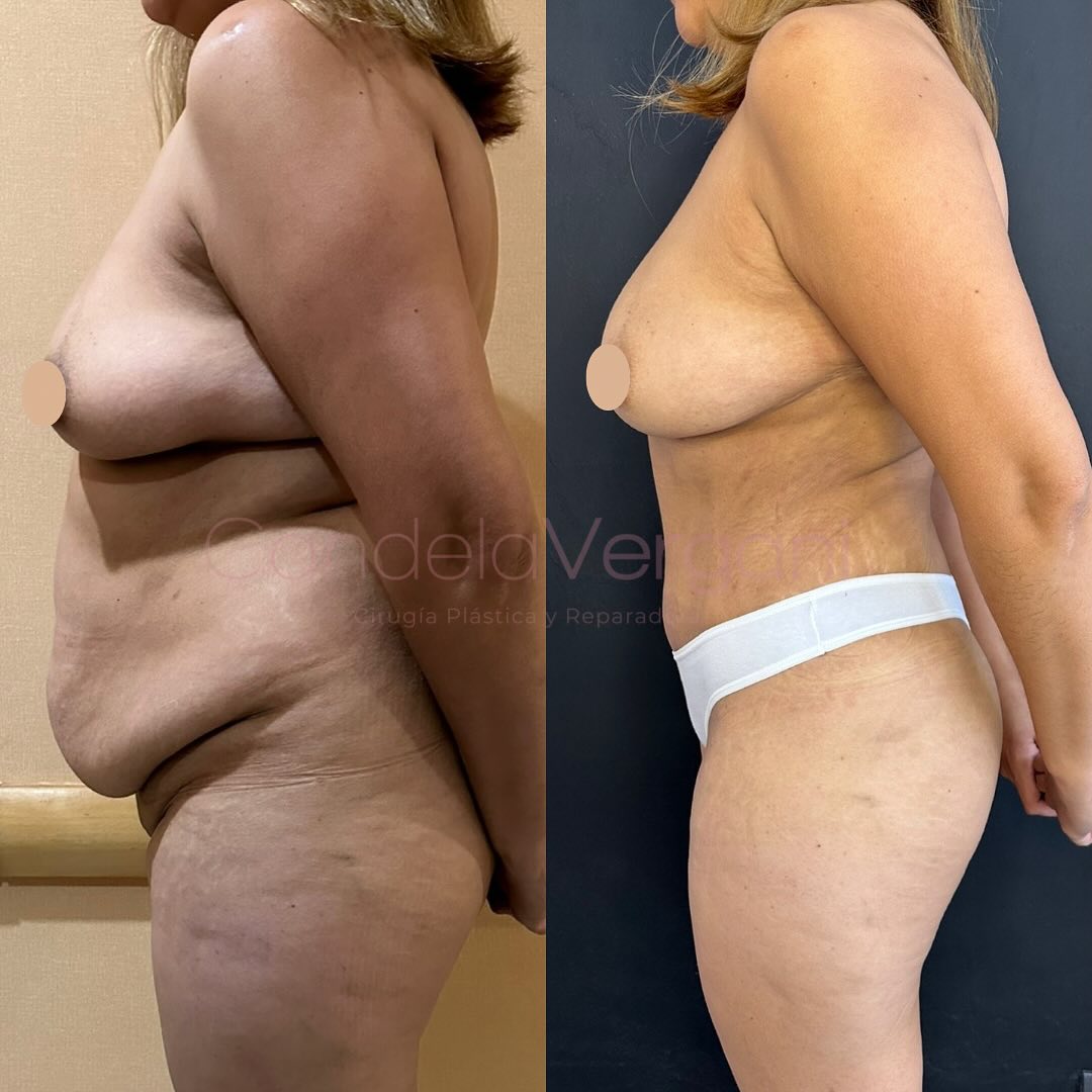 03d. lipoabdominoplastía