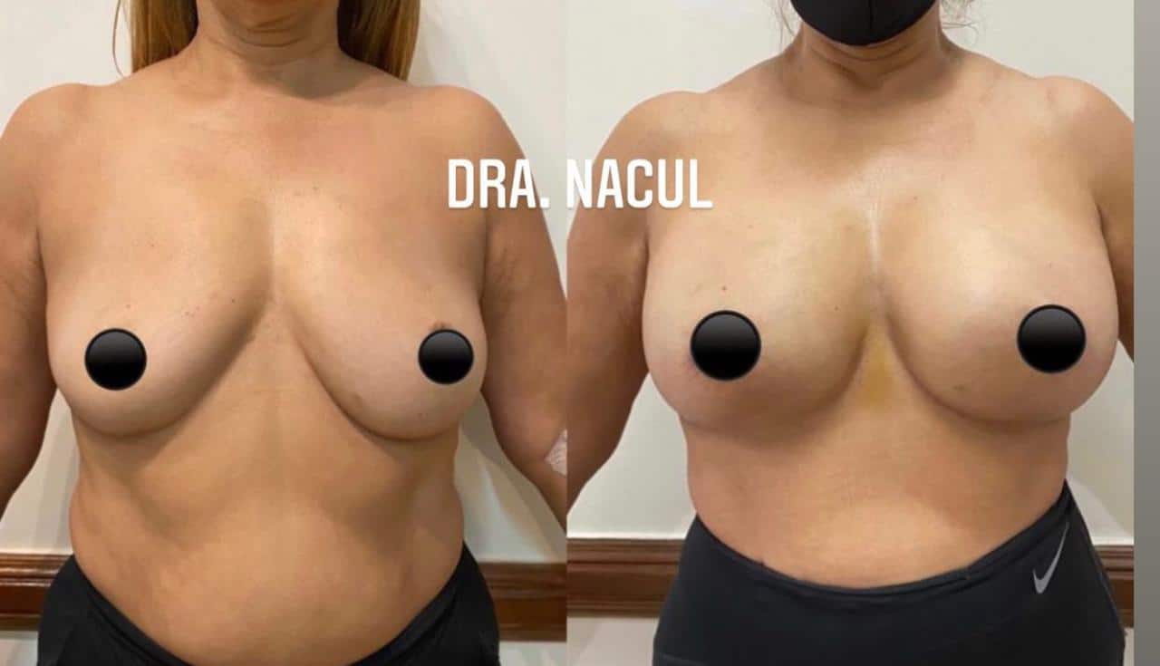 nacul3
