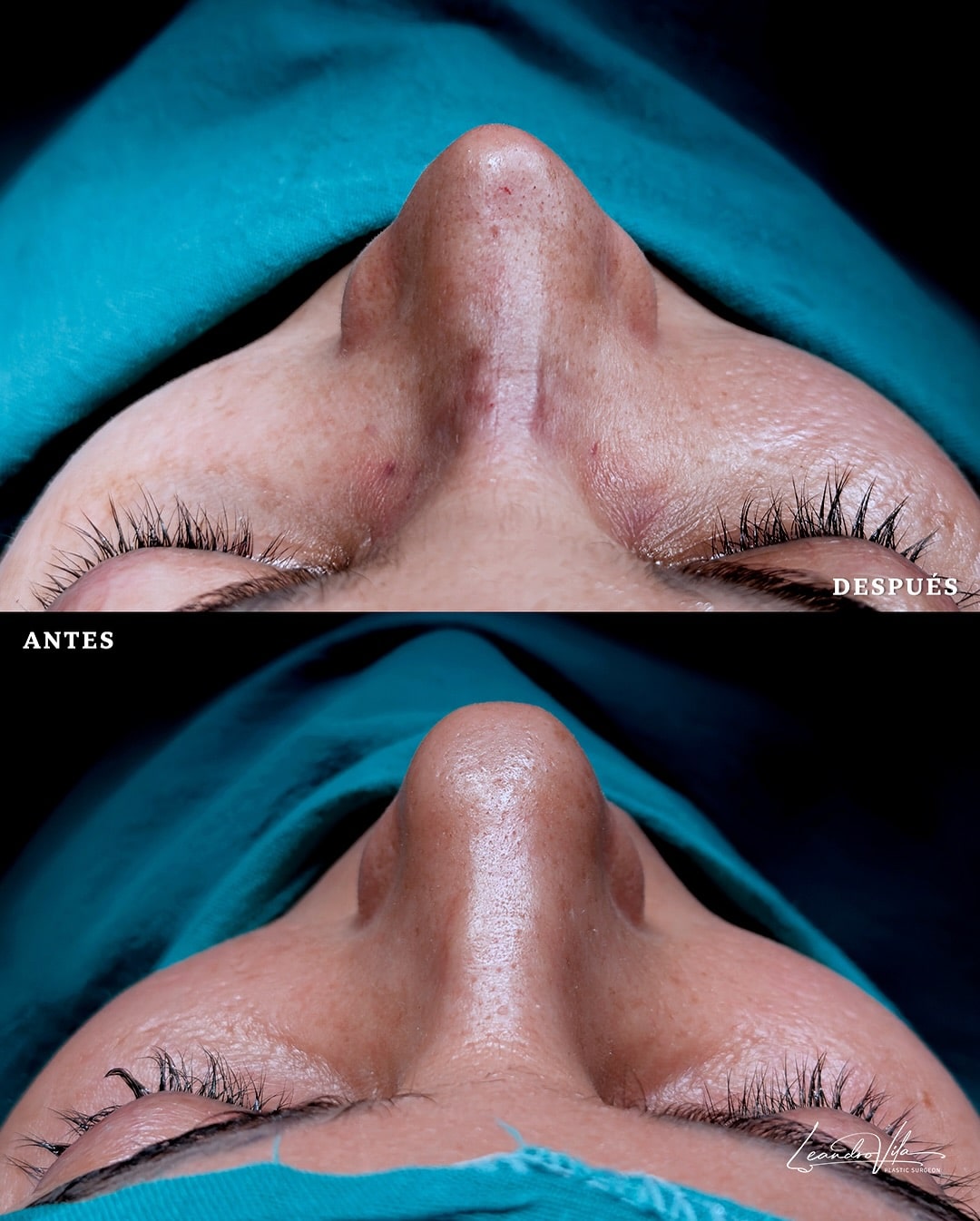 Rinoplastia