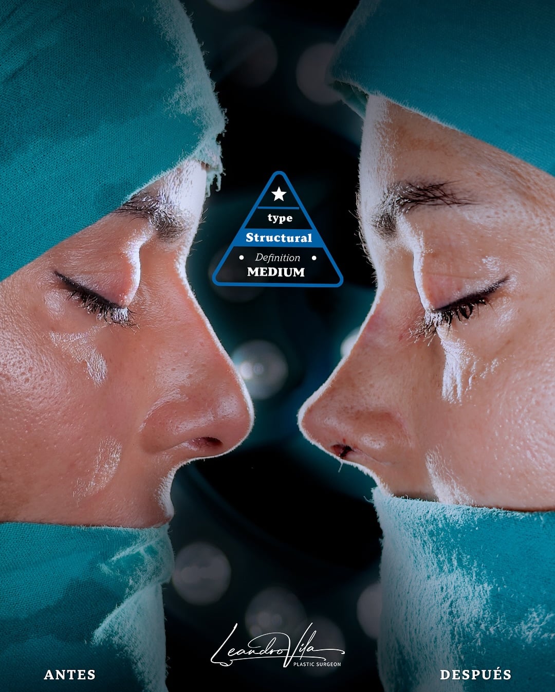Rinoplastia