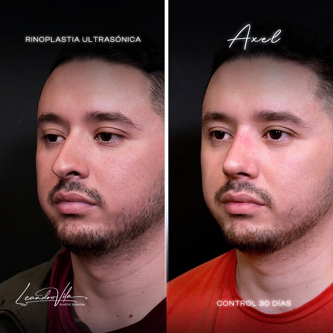 Rinoplastia ultrasónica