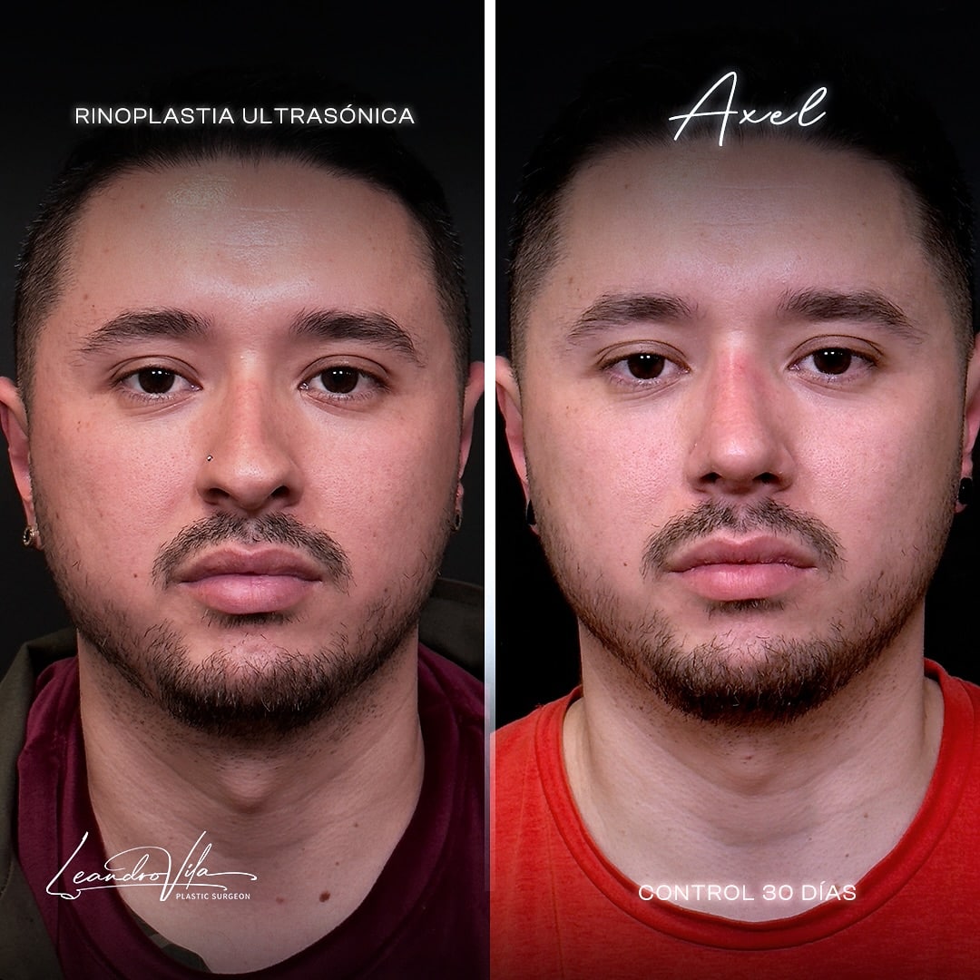 Rinoplastia ultrasónica