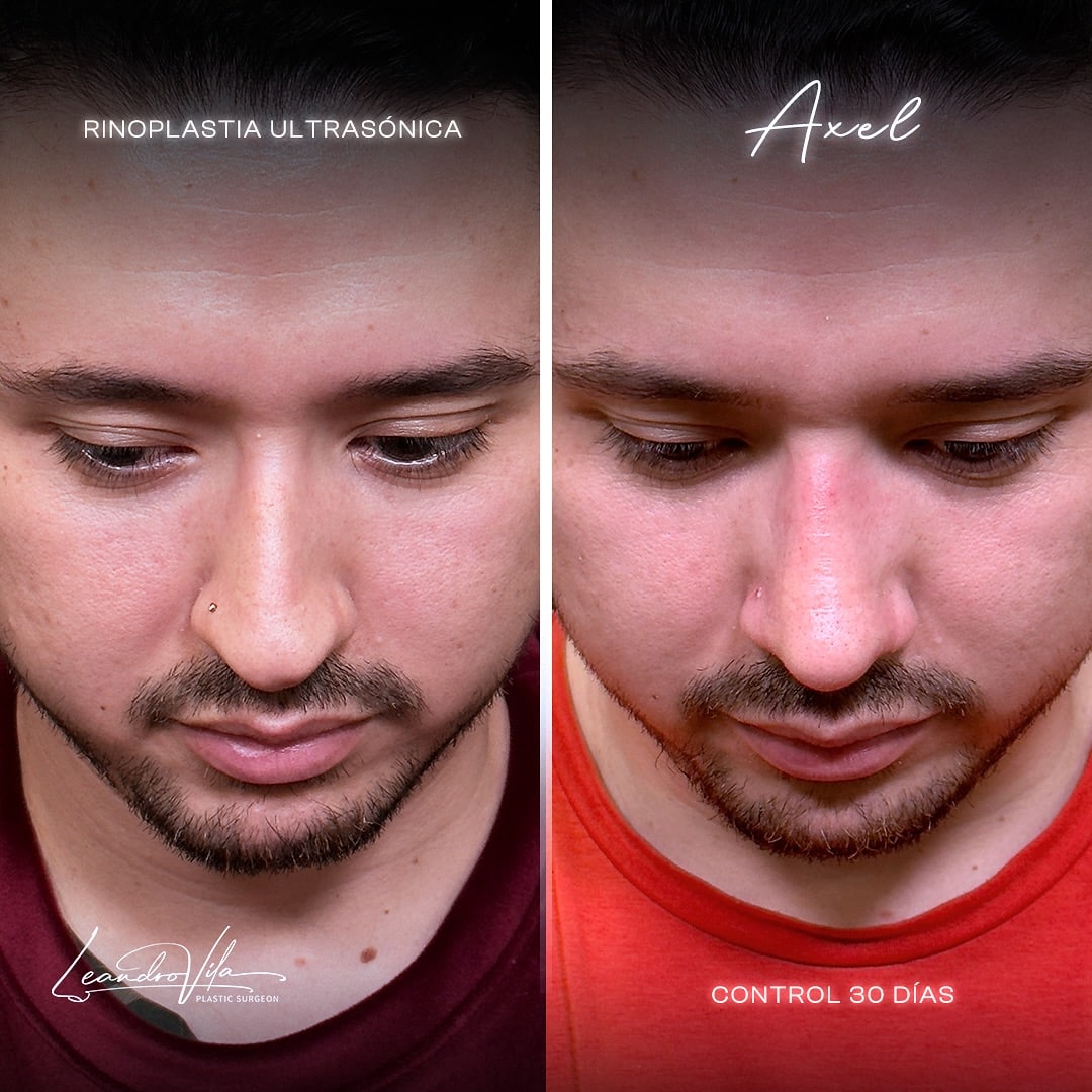 Rinoplastia ultrasónica