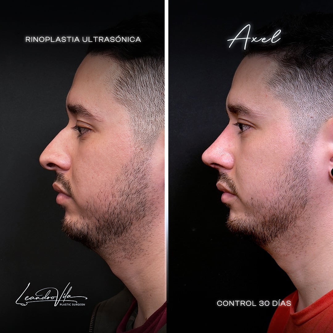 Rinoplastia ultrasónica