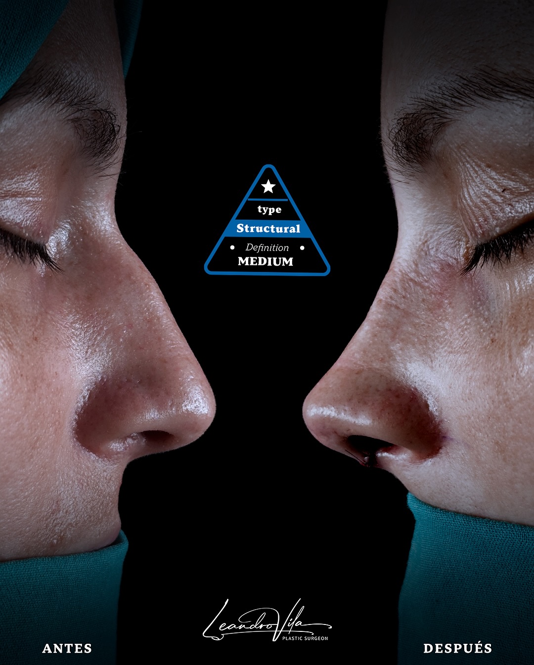 Rinoplastia ultrasónica